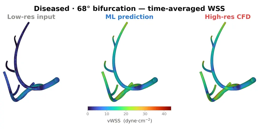 Three renders of the same diseased coronary artery tree coloured by time-averaged wall shear stress — the low-resolution input almost uniformly dark, the ML prediction and the high-resolution CFD reference nearly identical.